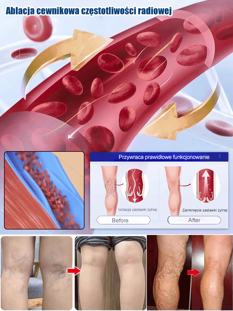 Spray do leczenia żył nóg
