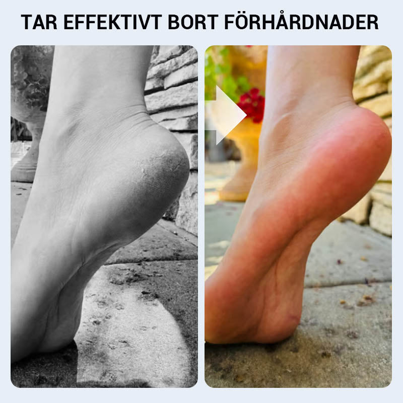 🔥 Praktyczny ręczny przyrząd do usuwania zrogowaciałego naskórka ze stóp🦶🏻